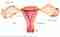 Endometriosis – Bienestar y Salud – WebMediums