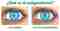 ¿Qué es el astigmatismo? – Bienestar y Salud – WebMediums