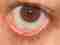 ¿Cómo tratar la cebada en el ojo? – Bienestar y Salud – WebMediums
